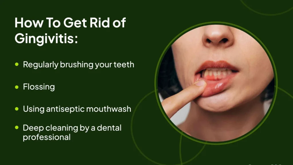 What Does Gingivitis Look Like