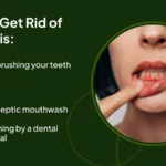 What Does Gingivitis Look Like