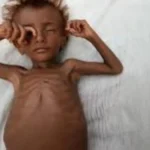 malnourished meaning